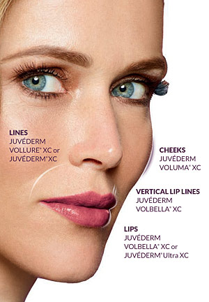 Juvederm