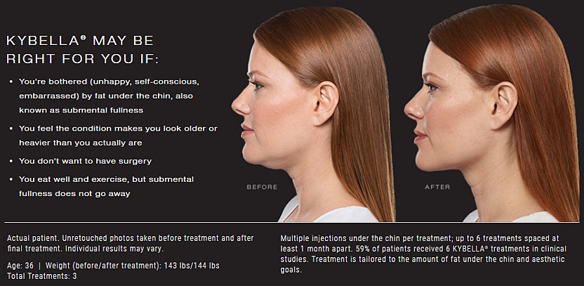 Kybella