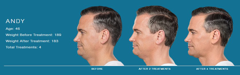 Kybella for Men