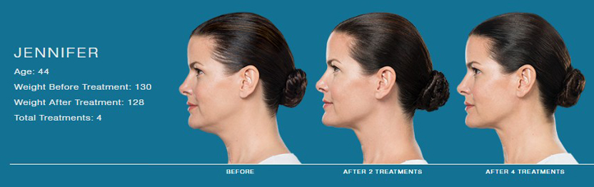 Kybella for Women