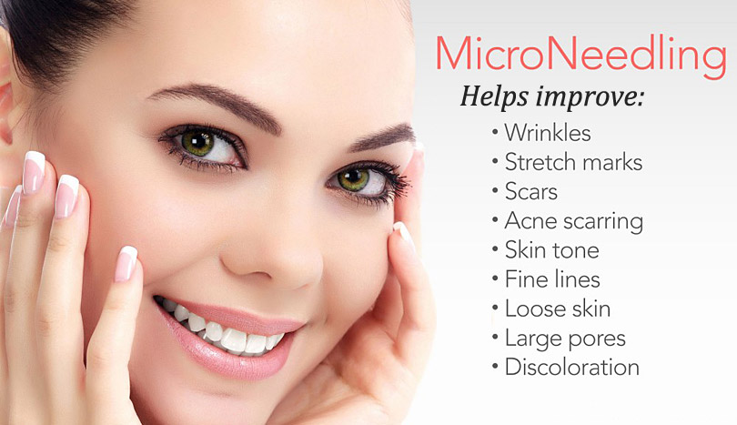 Microneedling